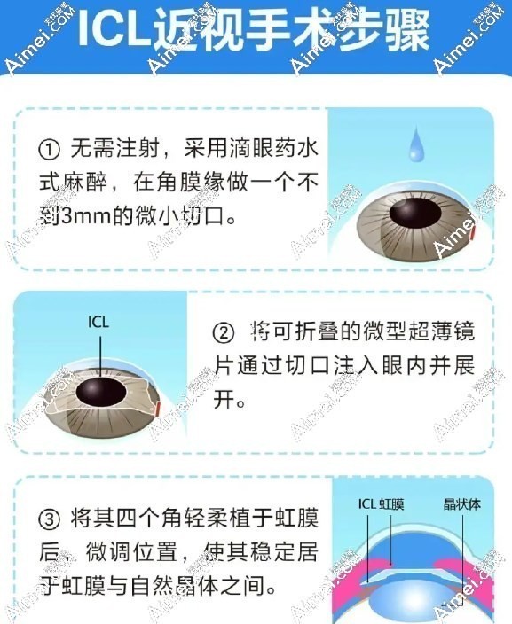 成都普瑞眼科医院艾碧君做icl手术步骤图解