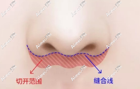国内人中缩短术这10位医生技术好 国内人中缩短术这10位医生技术好