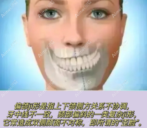 轻度偏颌正畸改变脸型大爱@美网