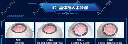 icl v4c晶体植入手术步骤