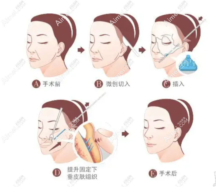 上海美莱小拉皮手术过程