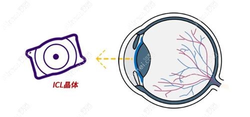 icl v4c后房晶体植入价格1.4万起步