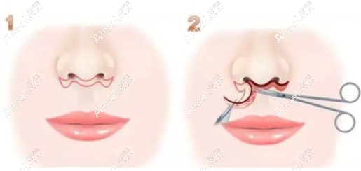 马群医生做人中缩短技术好 马群医生做人中缩短技术好
