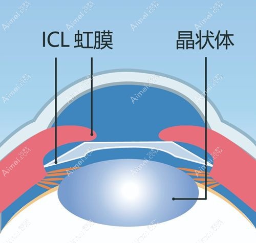 icl v4c晶体优缺点说明