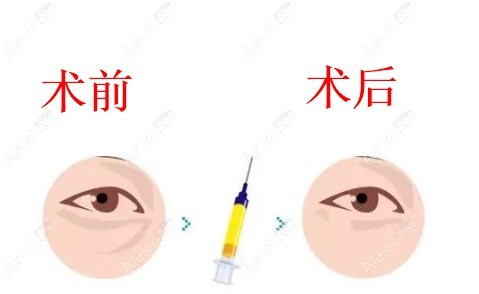 打完弗縵膠原即刻就有成效