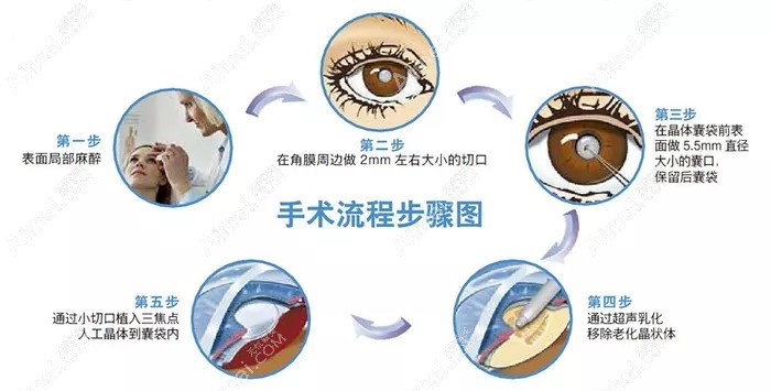 白內(nèi)障植入三焦點晶體手術(shù)過程