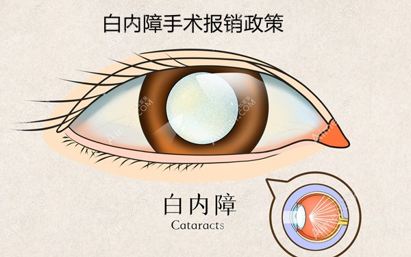 昆明白内障手术新农合报销比例50-80% 昆明白内障手术新农合报销比例50-80%
