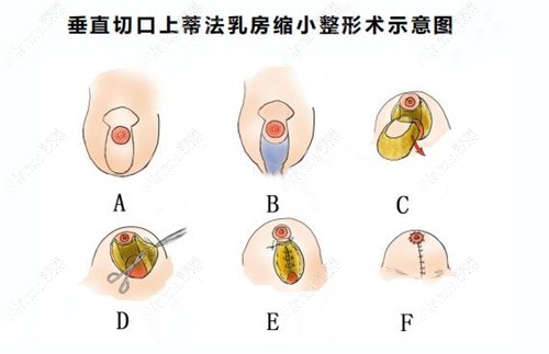 缩胸手术棒棒糖切口提升 缩胸手术棒棒糖切口提升