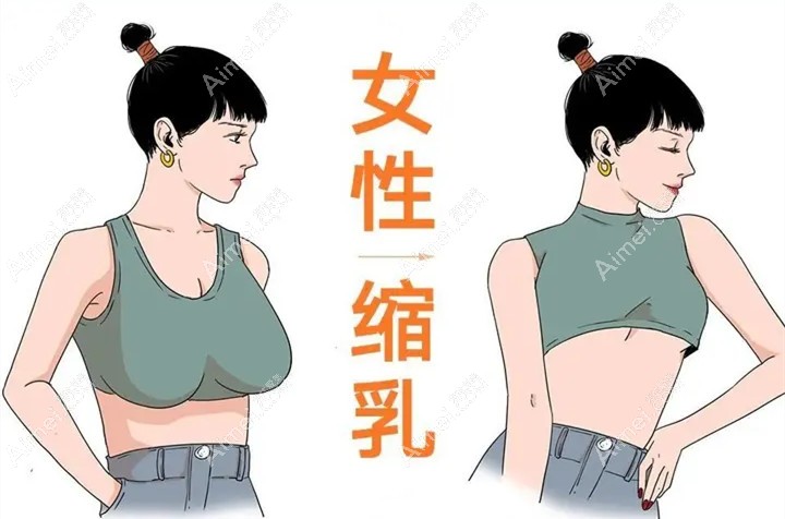 做过缩胸手术的人感言分享 做过缩胸手术的人感言分享
