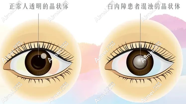 朱思泉醫(yī)生做白內(nèi)障手術(shù)怎么樣