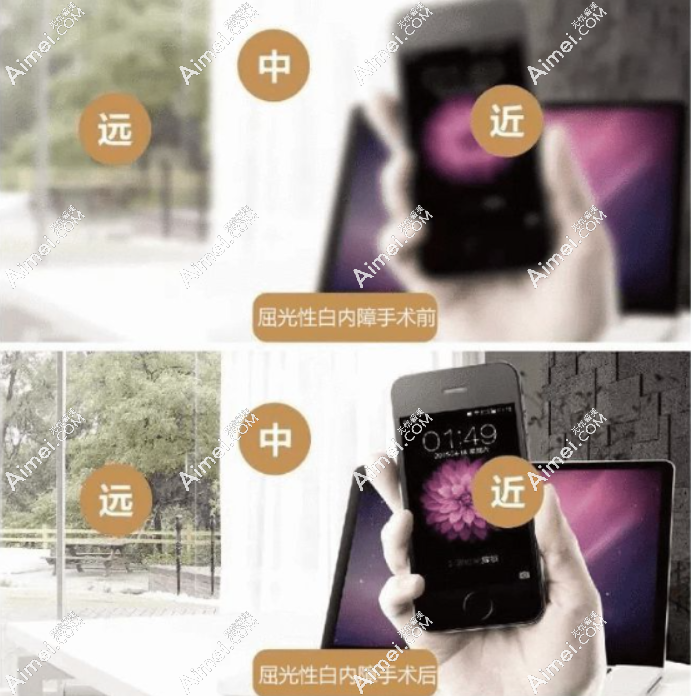 国产三焦晶体植入后看东西真实图像