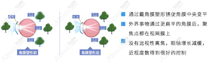 麥迪格眼科配角膜塑形鏡真的好