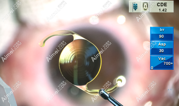 三焦晶体术后远视力很差正常吗?远视模糊多久可以恢复正常?