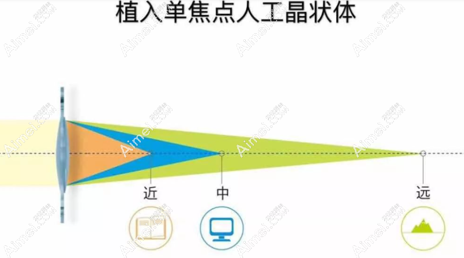 爱尔康sn6cws单焦点非球面人工晶体怎么样