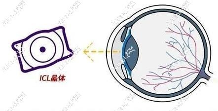 郑州做晶体植入手术好的眼科医院排名