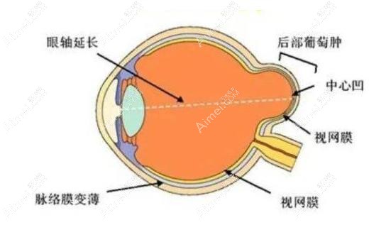 段安麗后鞏膜加固術(shù)成效
