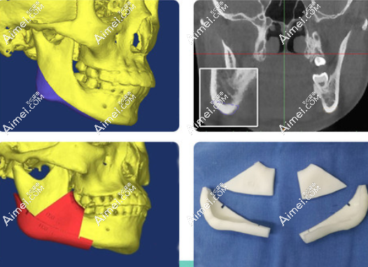 广大医院正颌3D导板技术 广大医院正颌3D导板技术