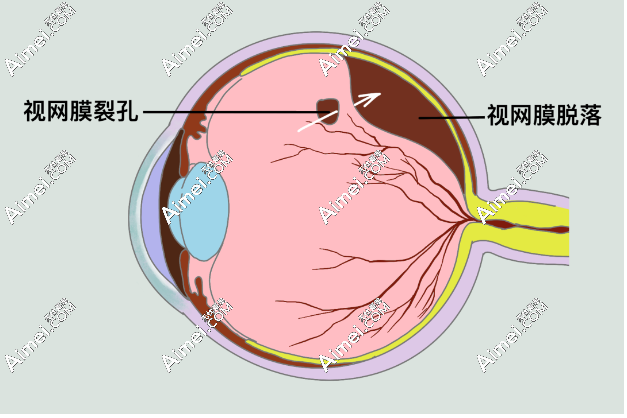 一只眼睛视网膜脱落手术费用大概多少钱