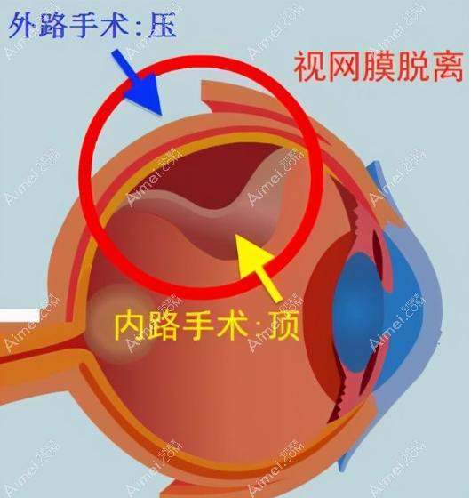 视网膜脱落手术方法有外路和内路两种