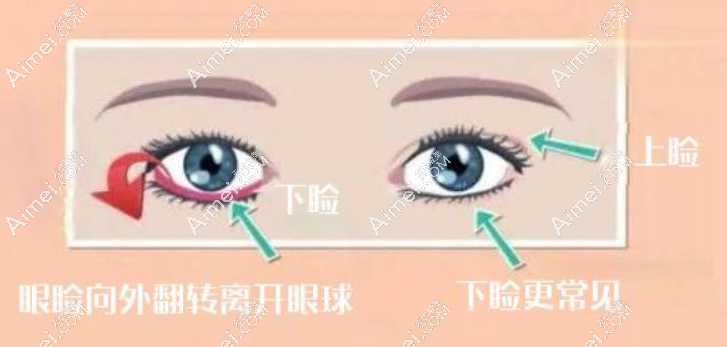 重度下眼睑退缩修复用什么方法好