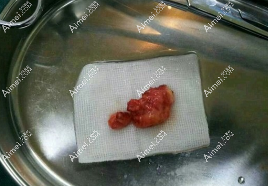 荔湾取生长因子真的干净