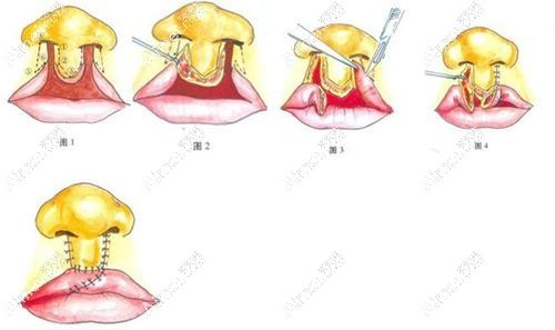 余文林修复唇裂实例分享