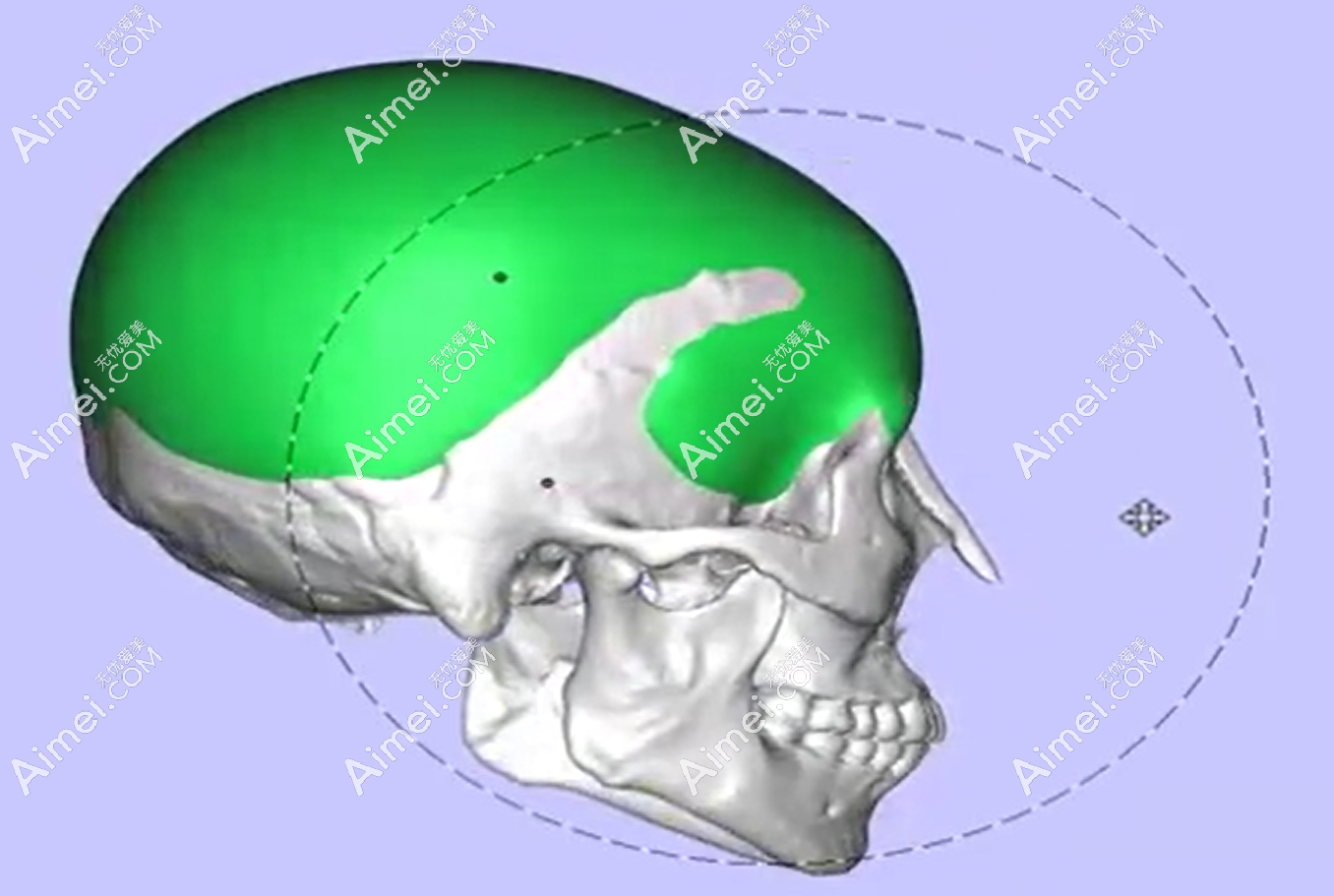 上海时光整形医院何晋龙后脑勺3D手术