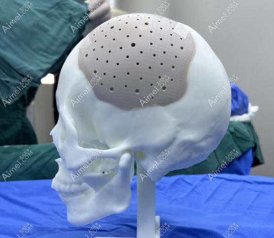 何晋龙后脑勺PEEK填充手术