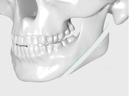 赵延峰磨骨手术风格解析