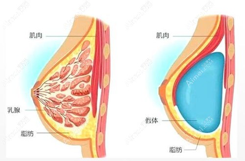 唐毅隆胸技术图