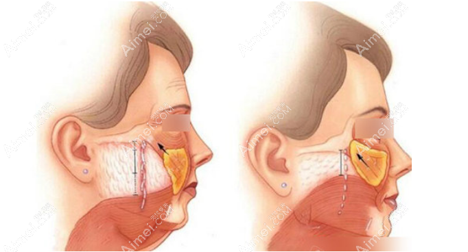 北京黄寺杜太超做拉皮手术能维持多久