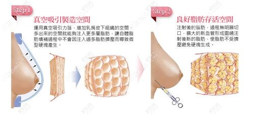 冯斌脂雕丰胸价格30万贵在哪儿 冯斌脂雕丰胸价格30万贵在哪儿