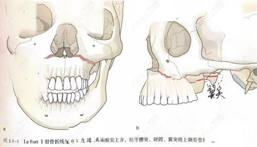 王涛正颌手术会截骨吗? 王涛正颌手术会截骨吗?