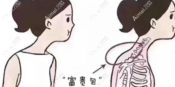 曹孟君富贵包抽脂怎样 曹孟君富贵包抽脂怎样