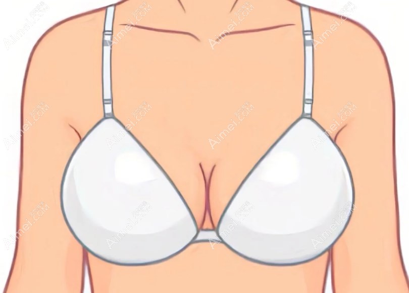 内窥镜隆胸 内窥镜隆胸