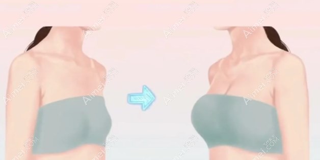 李高峰隆胸技术 李高峰隆胸技术