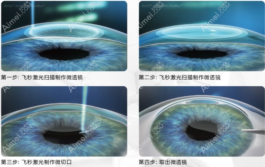 全飞秒近视手术