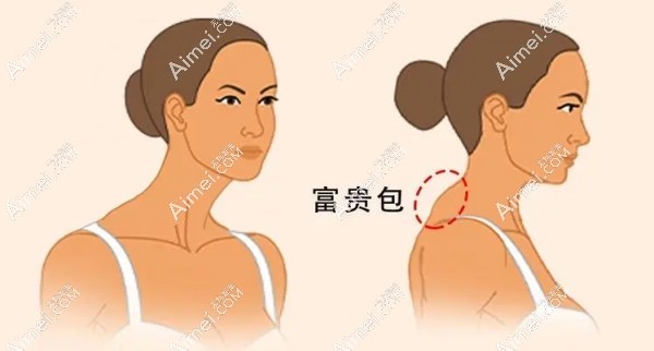 曹孟君做富贵包不会有后遗症