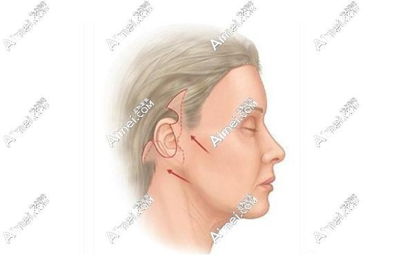 黄寅守医生做面部提升的优势解析