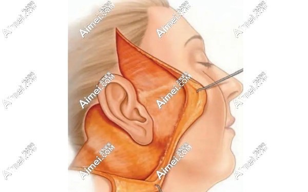 穆宝安医生做面部拉皮手术好