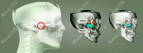 張笑天和黃大勇磨骨手術(shù)風(fēng)格對(duì)比
