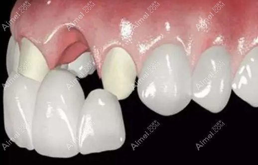 缺牙安烤瓷牙好還是安假牙好