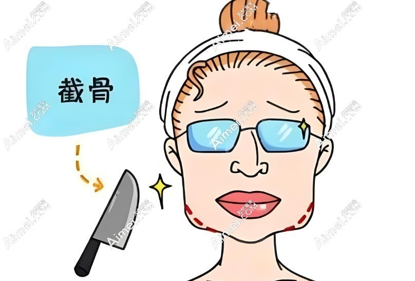 北京張笑天醫(yī)生磨骨風格自然
