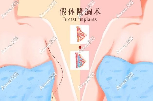 深圳假体隆胸价格表全新曝光:曼托\敖诺拉\娜高假体价格一览