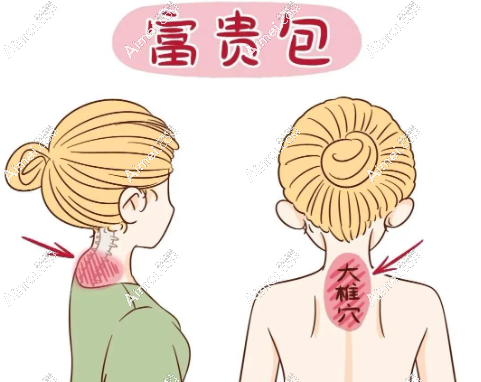 北京富贵包手术