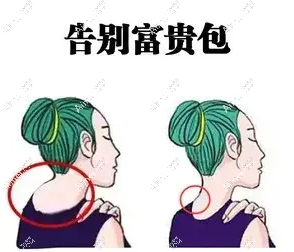 北京富贵包抽脂手术多少钱