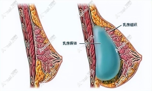 假体隆胸和自体脂肪隆胸哪个真实