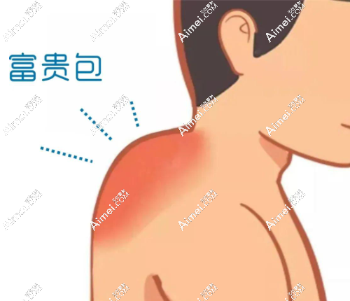 北京富贵包手术大概多少钱?韦元强做富贵包微创术8000/王明利做7000元起