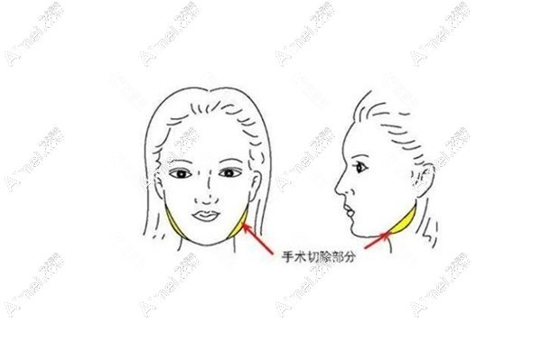 張笑天醫(yī)生做下頜角/顴骨手術(shù)好aimei.com