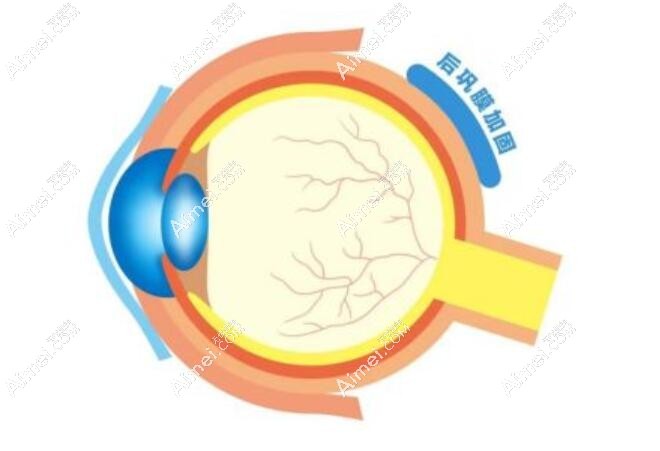 后巩膜加固术 后巩膜加固术